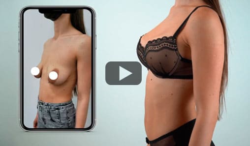Breast lift with implant augmentation 280 ml Breast lift with implant augmentation 280 ml