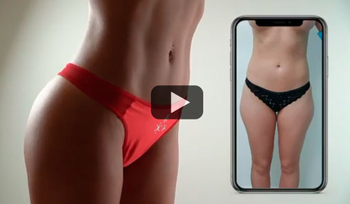 Liposculpture of 10 areas with the formation of an athletic abdomen and buttocks Liposculpture of 10 areas with the formation of an athletic abdomen and buttocks